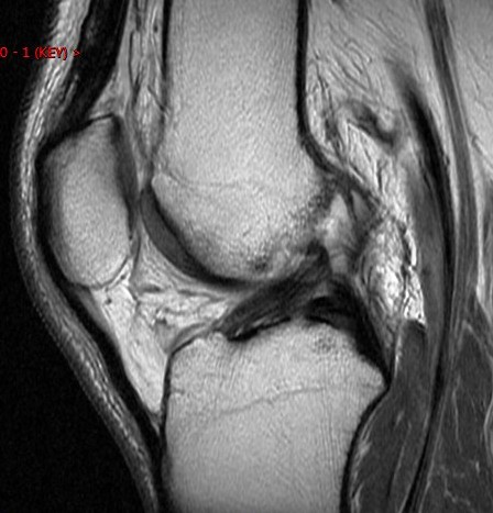 Figure 4 for case bucket-handle tear and ACL tear( RID4725 )( RID2781 )